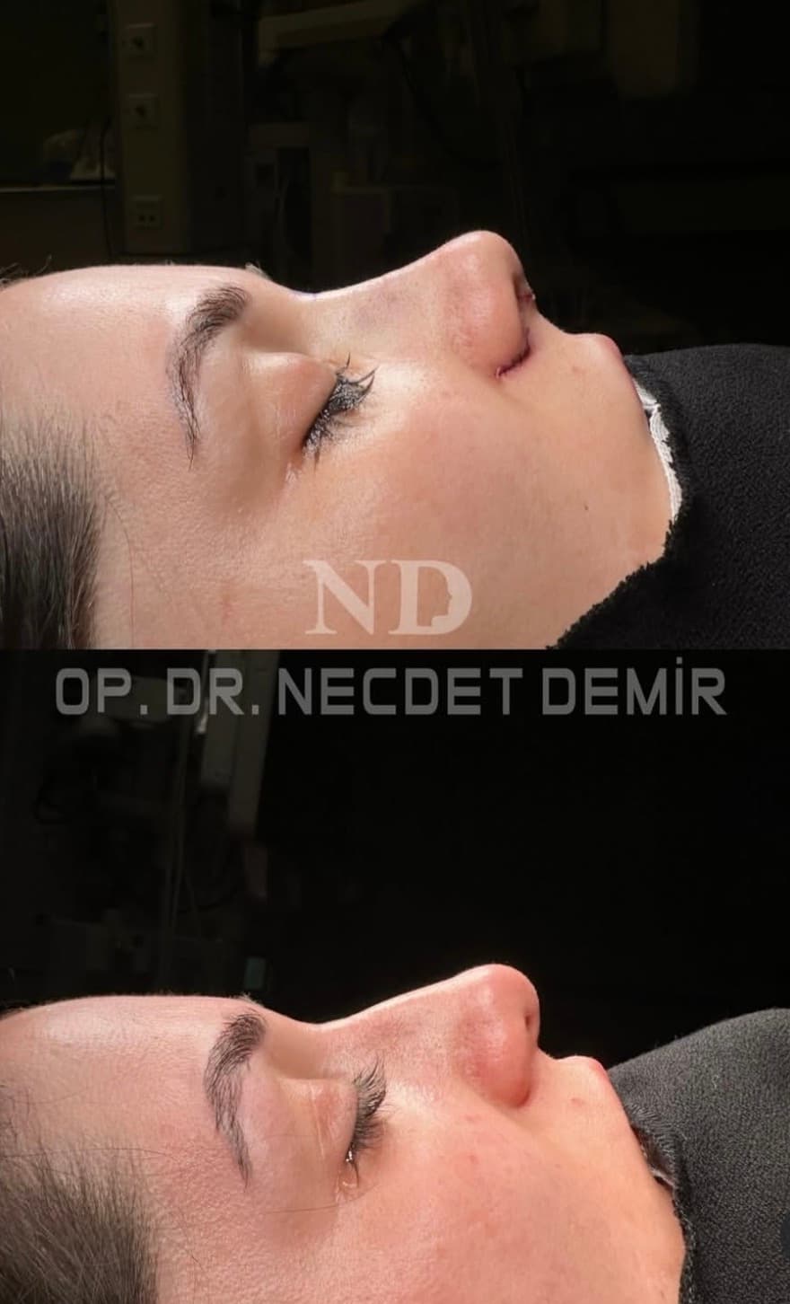 Rhinoplastie avant et après — Harmonie du profil