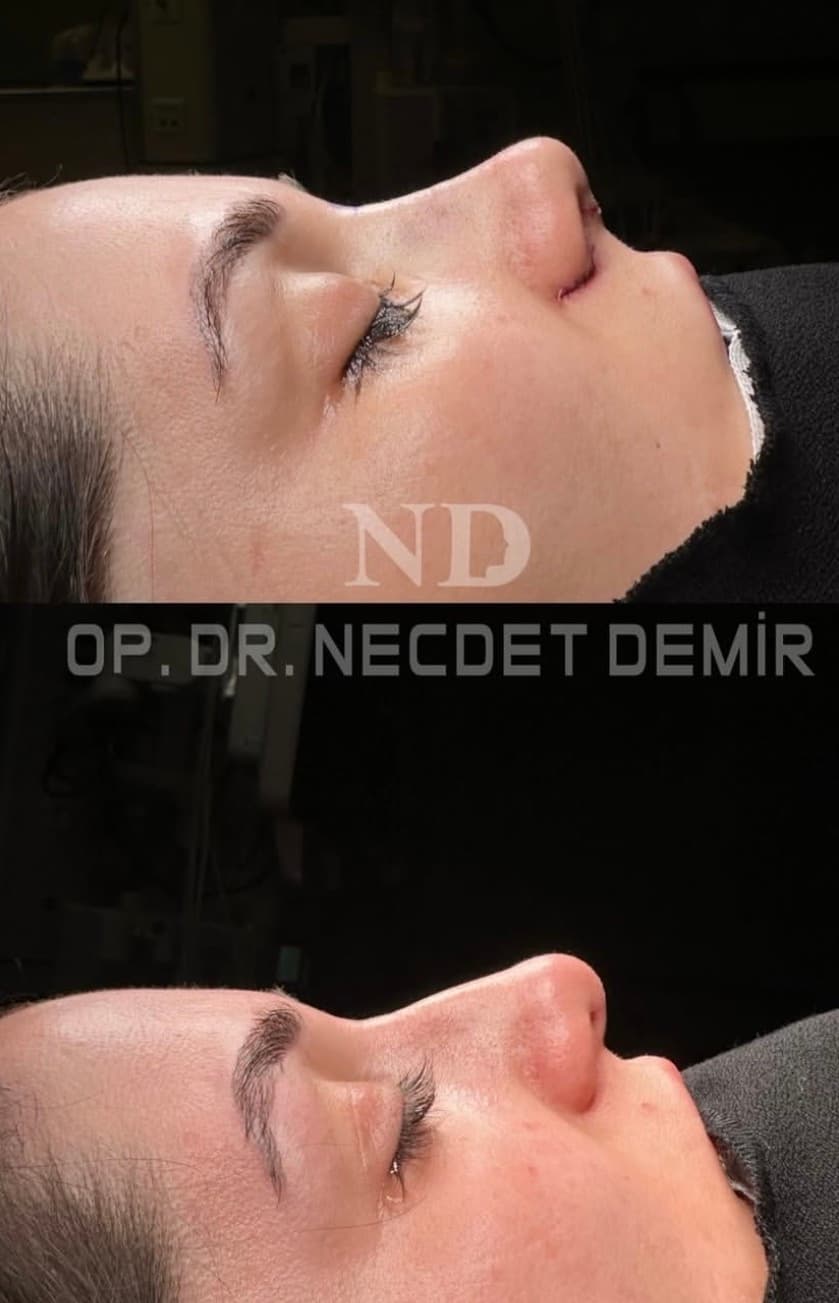 Rhinoplastie avant et après — Transition naturelle