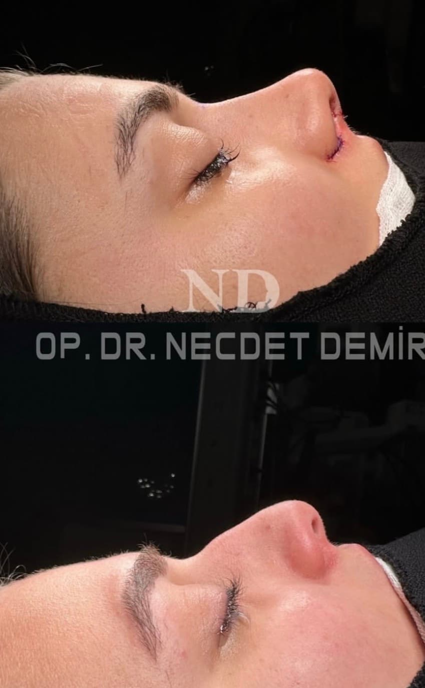 Rhinoplastie avant et après — Définition de la pointe