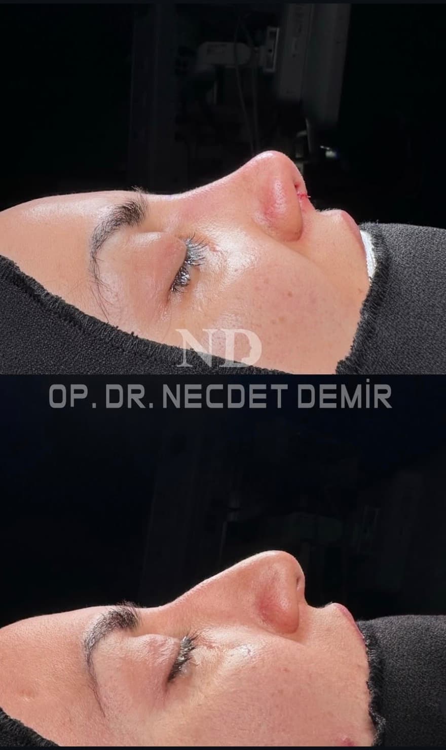 Rhinoplastie avant et après — Symétrie