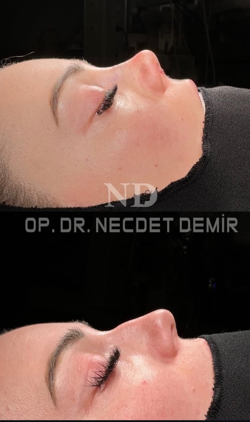 Rhinoplastie avant et après — Harmonie globale