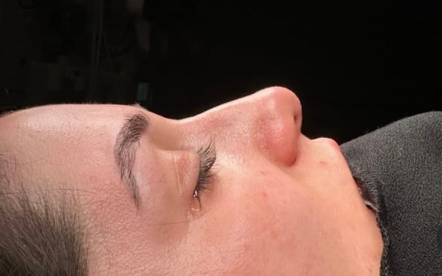 تجميل الأنف — انسجام الجانب — بعد