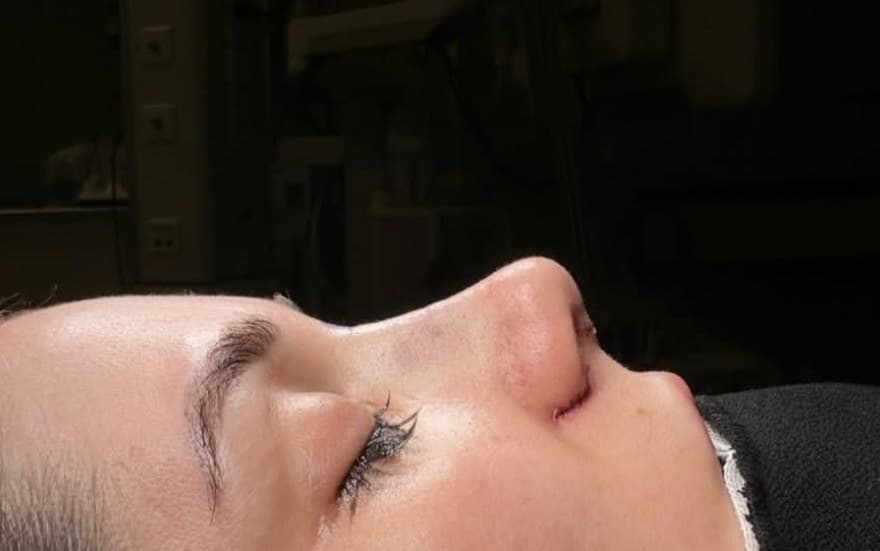 تجميل الأنف — انسجام الجانب — قبل